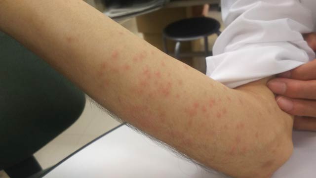 毒針毛が刺さった患部に炎症が発生している様子（新潟県が三条市に提供下写真）