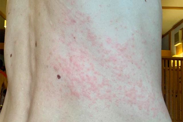 毒針毛に刺された背中